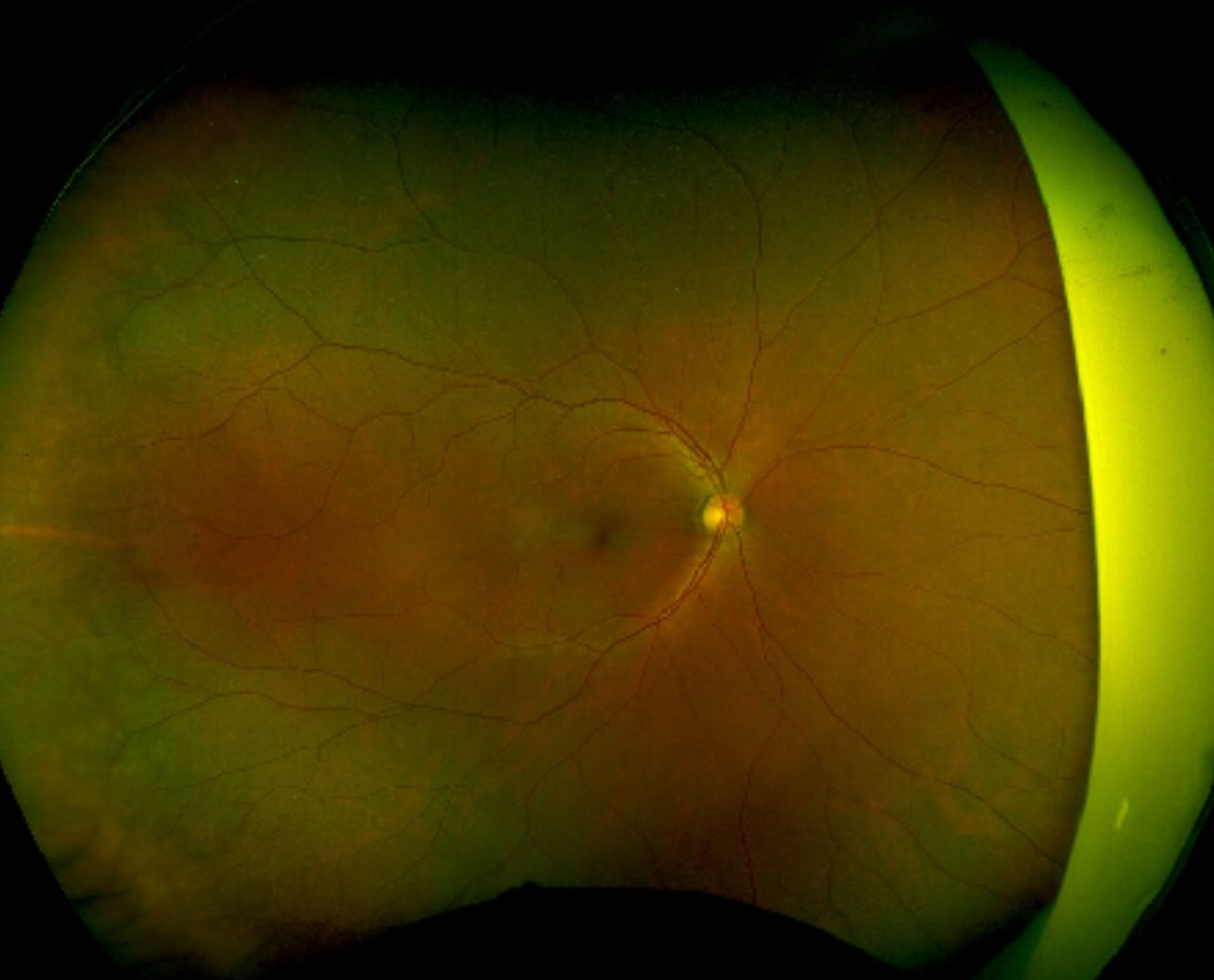 Optical coherence tomography shows multiple bilateral exudative retinal detachments, outer retinal cysts and thickened choroids.