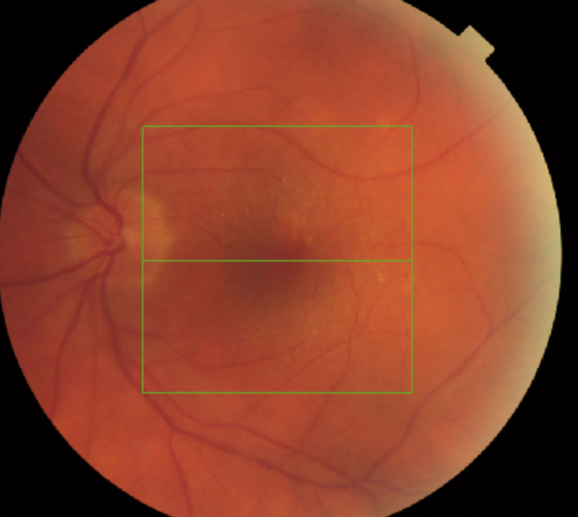 Optical coherence tomography shows multiple bilateral exudative retinal detachments, outer retinal cysts and thickened choroids.