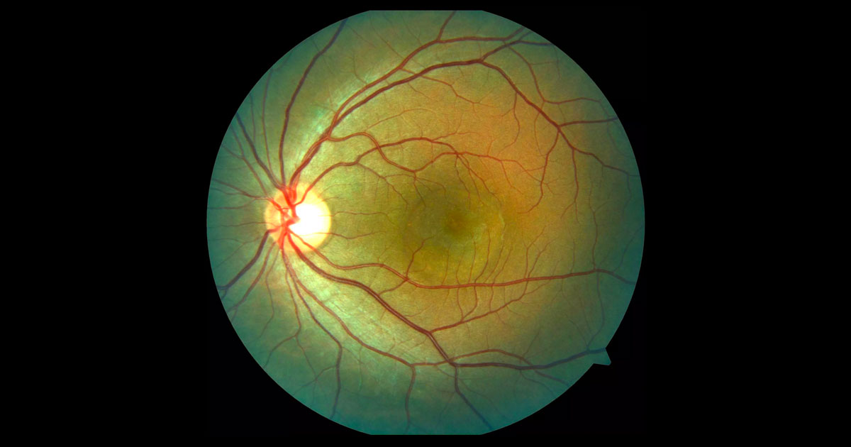 A localised elevation is present at the left macula. Multiple subtle dot like yellow precipitates are visible within the serous detachment.