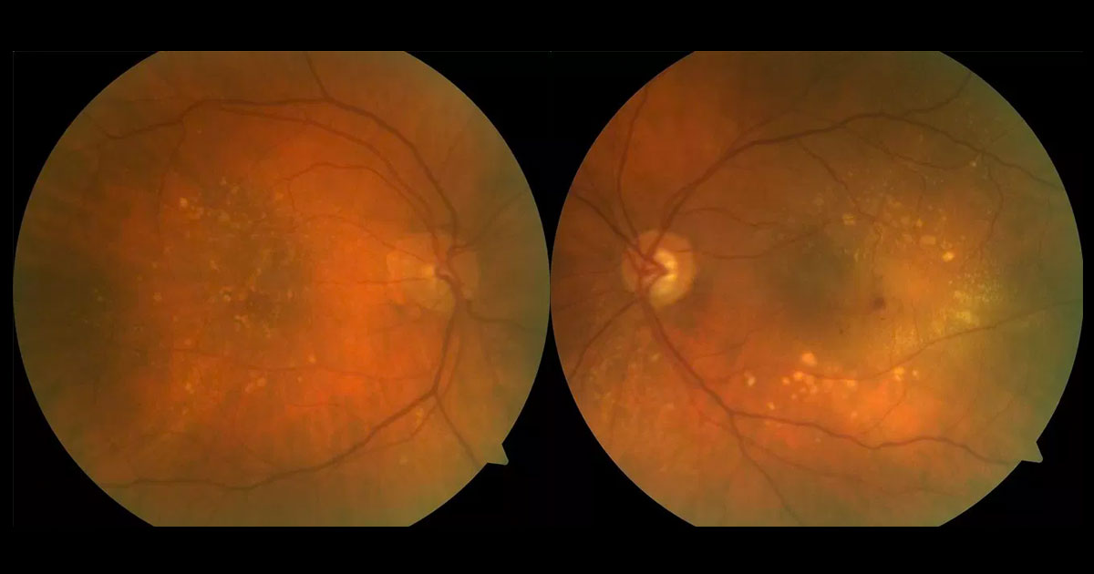 Colour fundus photography of the left eye shows central intra retinal haemorrhage, surrounded by peri-macular soft and hard drusen.