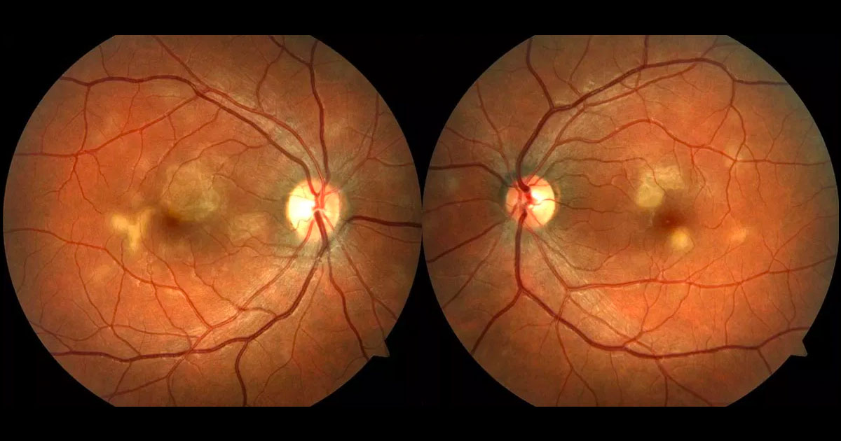 Colour fundus photographs showing bilateral multiple cream coloured deep retinal placoid lesions. The right fovea is involved.