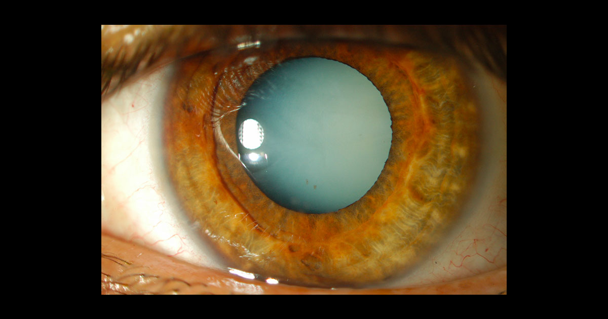 Figure 1: White cataract left eye