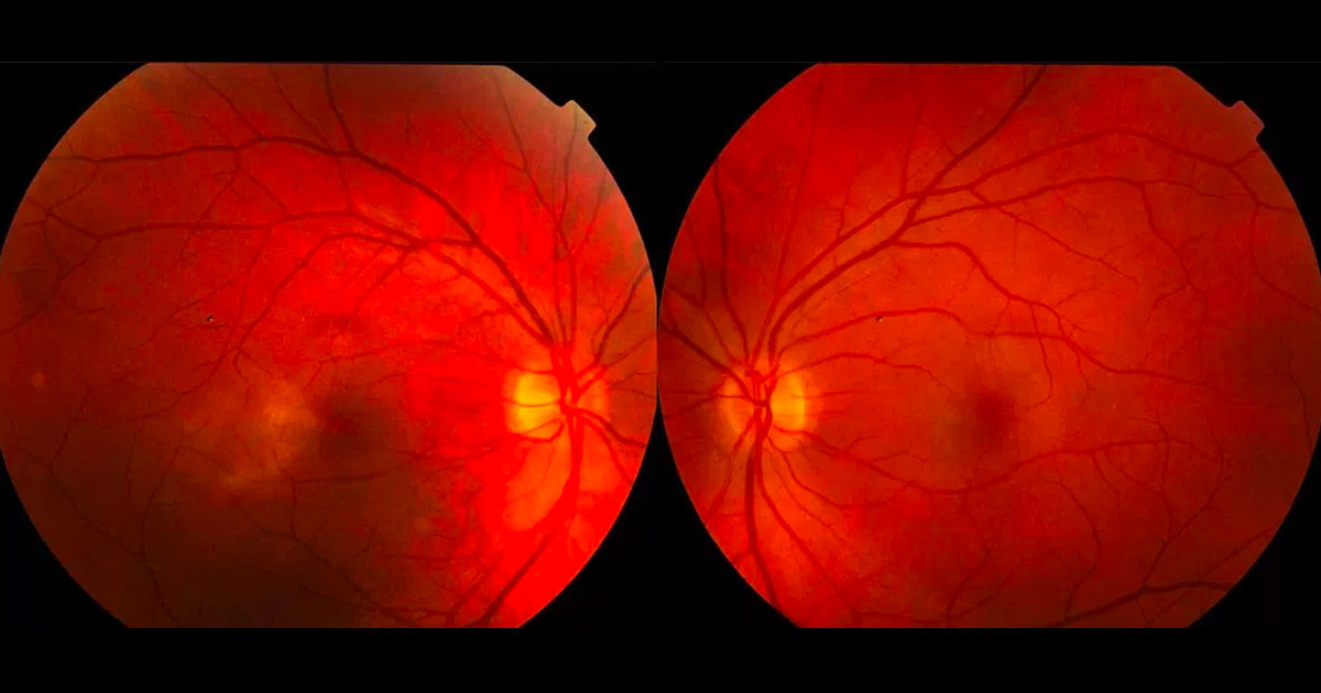 Colour photographs demonstrate alteration of the foveal reflex with loss of transparency temporal to the maculae, more evident in the right eye.