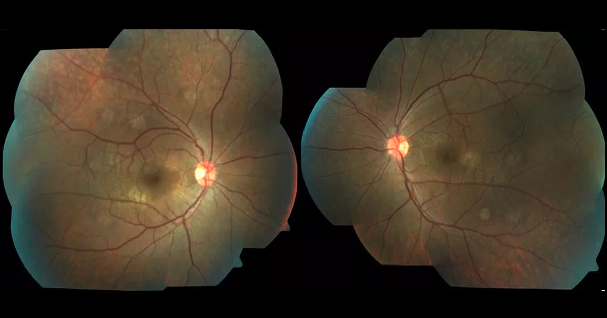 Colour fundus photography demonstrating perimacular flecks at both maculae.