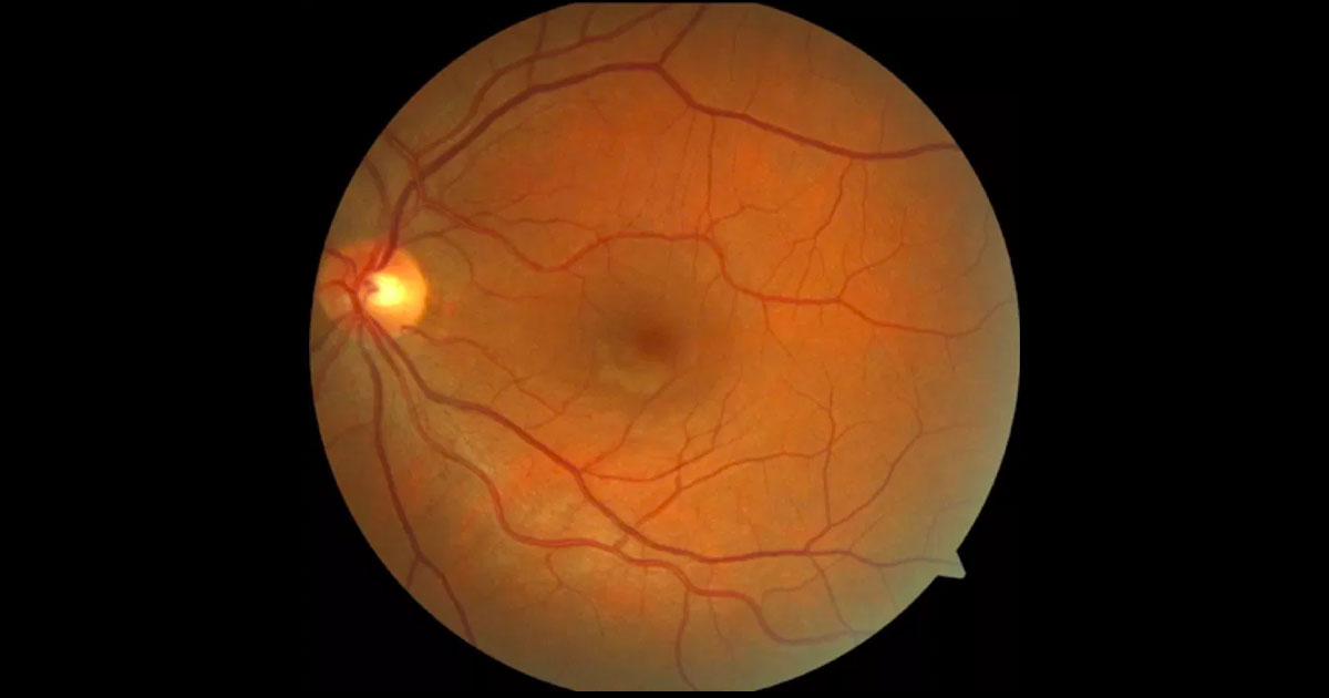 A small white lesion is visible just inferior to the left fovea.