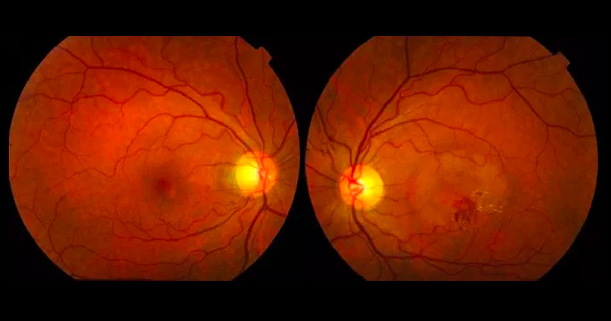 Colour fundus photographs shows a circular area of macular elevation associated with haemorrhage and hard exudate in the left eye.