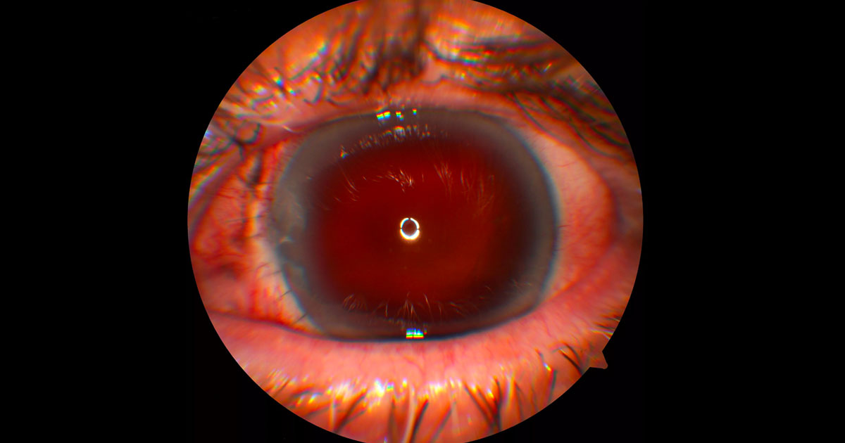 Anterior segment photo of the left eye following primary repair of a globe rupture. The nasal limbal rupture has been closed with interrupted nylon sutures. The eye is aphakic and there is no view of the retina due to a dense vitreous haemorrhage.