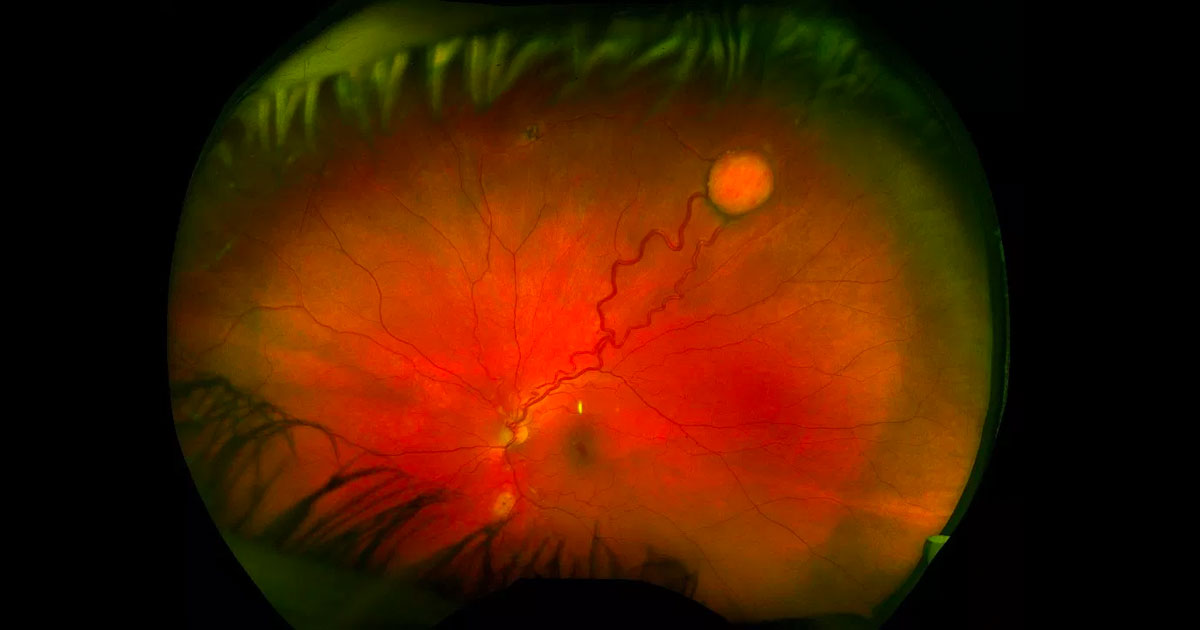 A round yellow-orange retinal lesion is visible in the superotemporal periphery of the left eye. There are dilated retinal vessels entering and exiting it.