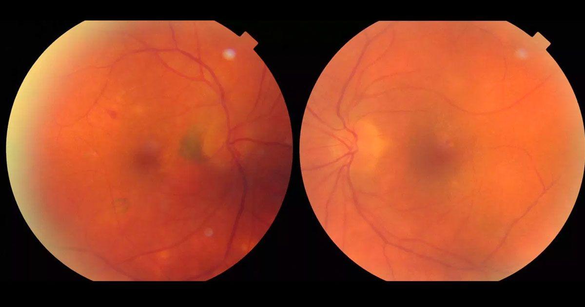 Colour fundus photographs show peripapillary and inferotemporal pigmentary changes in the right eye. There are some retinal pigment epithelial changes at the left macula and irregularity of the retinal vasculature.