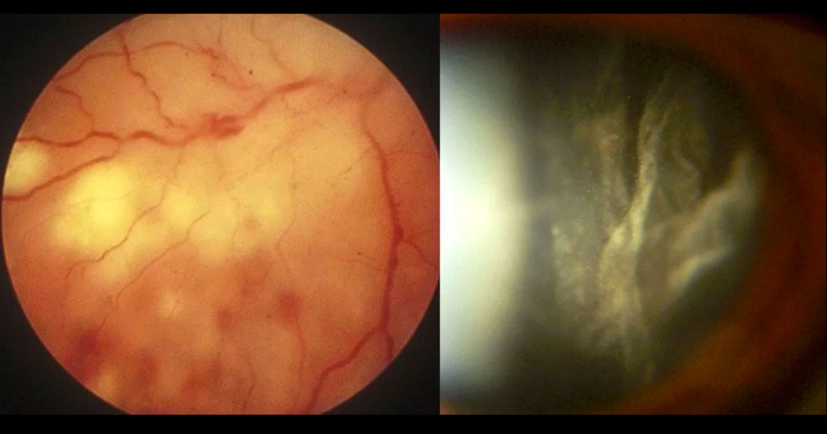 Colour fundus photograph of the right eye demonstrates white necrotic retinitis with intraretinal haemorrhages (left image). A moderate vitritis was present (right image).