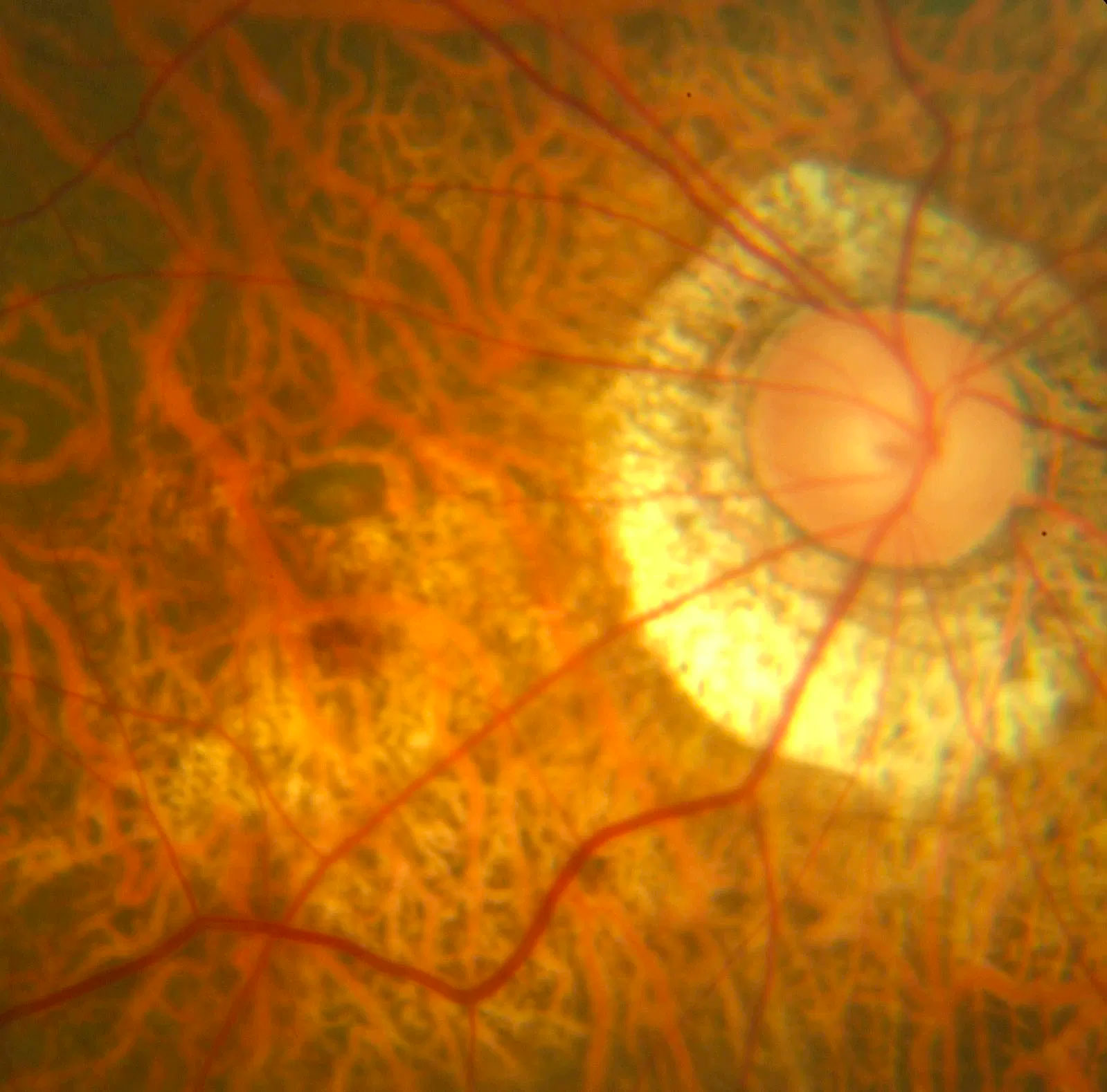 Pathological Myopia