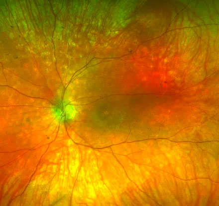 Inherited retinal diseases